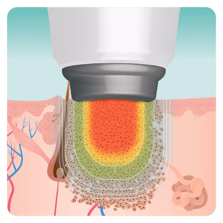 Illustration showing a laser device targeting hair follicles beneath the skin surface.